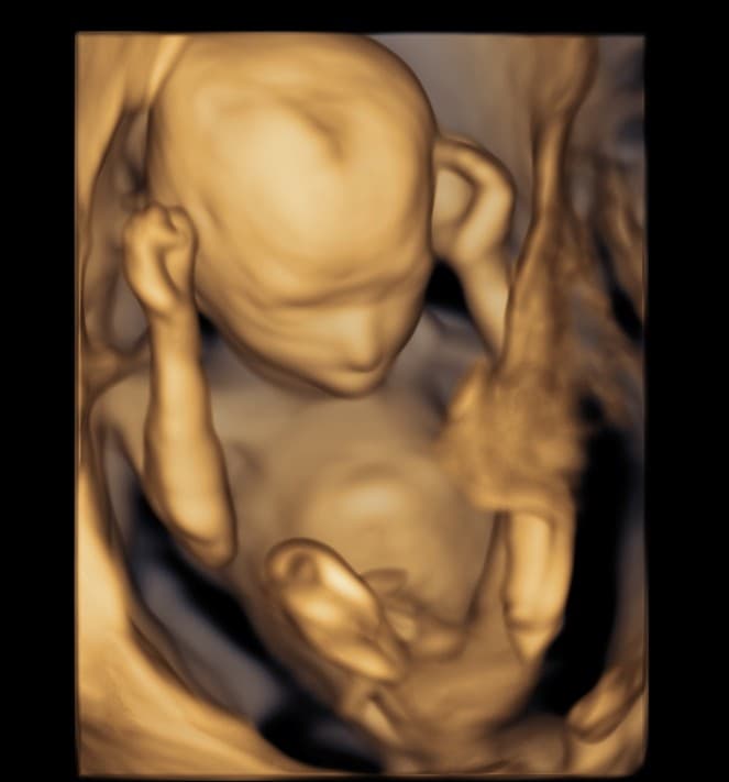 Golden 3D ultrasound of a baby at about 20 weeks with hands resting near the head