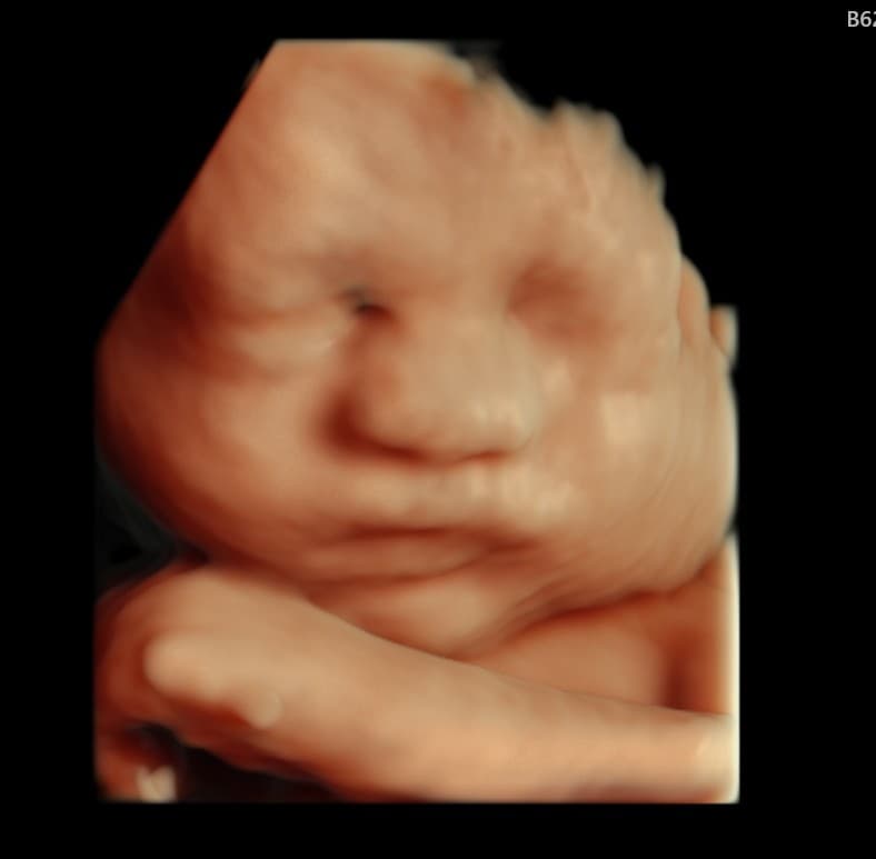 HD 3D ultrasound of a baby's face with soft realistic lighting and clearly defined cheeks, nose and lips