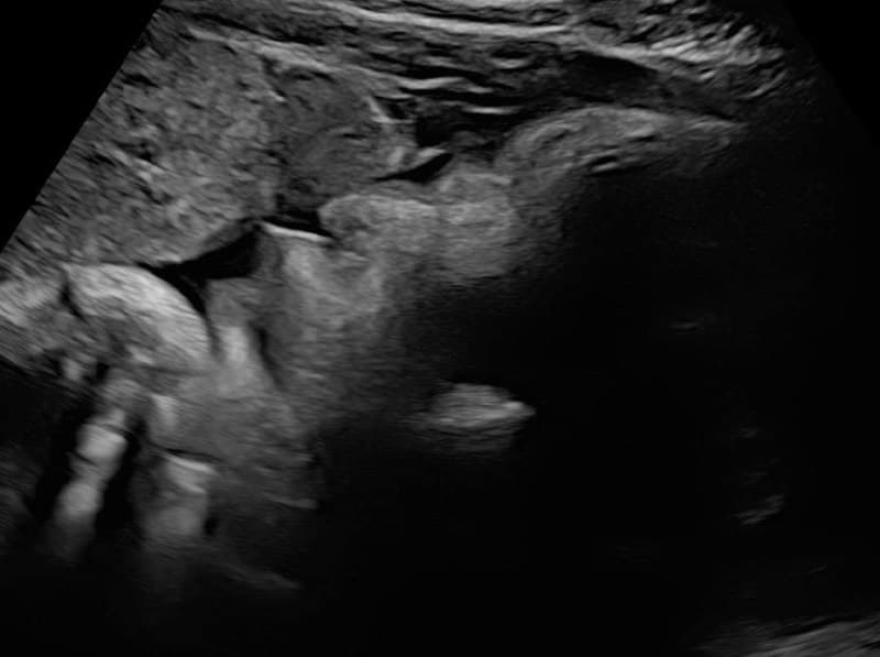 Ultrasonido con placenta anterior, rostro del bebé más difícil de ver