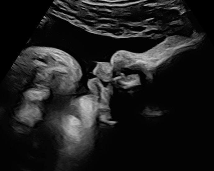 Ultrasonido con placenta posterior, rostro del bebé nítido