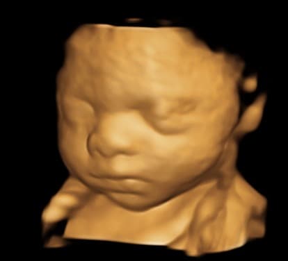 Classic 3D ultrasound of a baby's face in a golden sepia tone showing depth and facial features