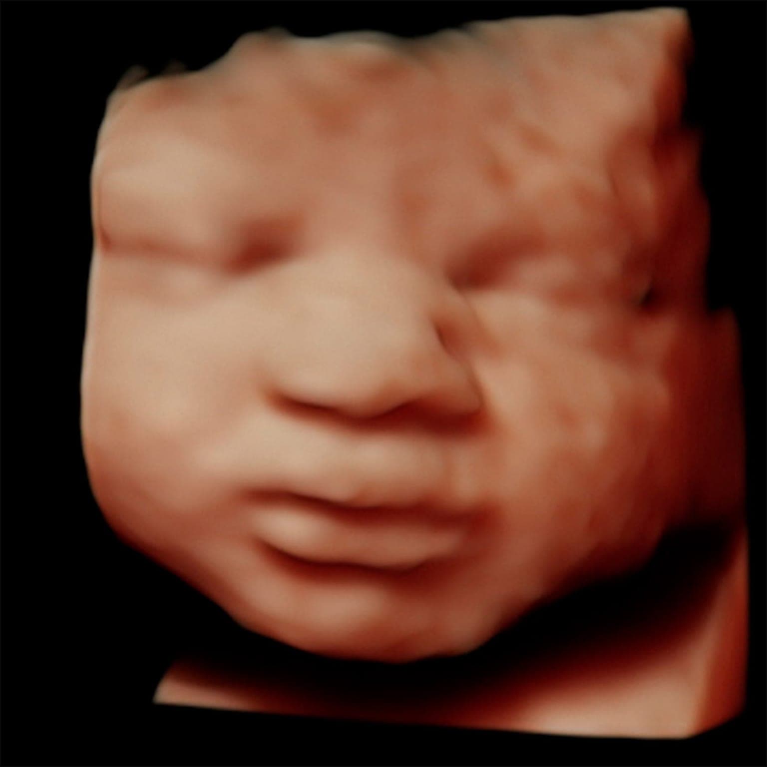 4D ultrasound image of a baby's face with round cheeks and closed eyes shown in warm skin tones