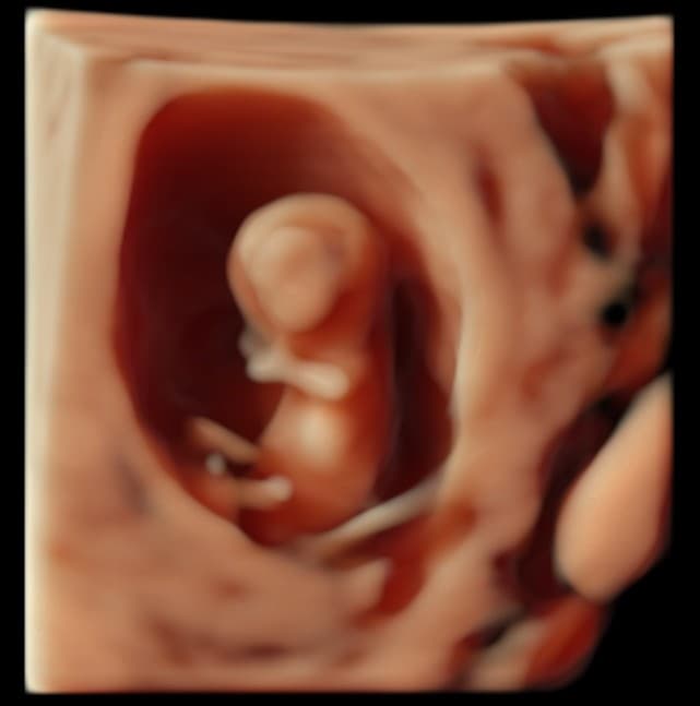 Early 3D ultrasound image of a tiny baby at about 10 weeks inside the gestational sac