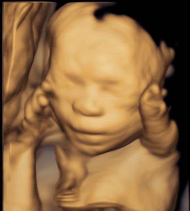 Detailed golden 3D ultrasound of a baby's face at about 27 weeks with a hand by the cheek