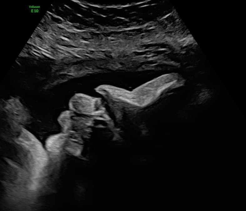 Week 32 ultrasound