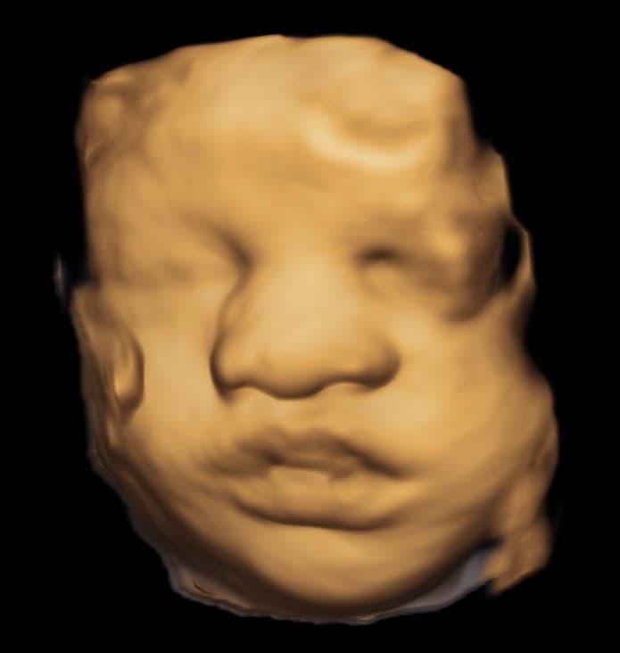 3D ultrasound of a baby's face showing a round nose and full lips in warm golden tones