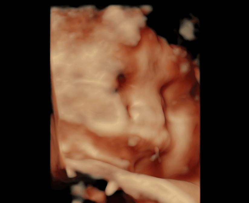 Low fluid intake baby ultrasound, blurry face