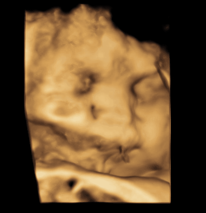 Low fluid intake baby ultrasound, blurry face