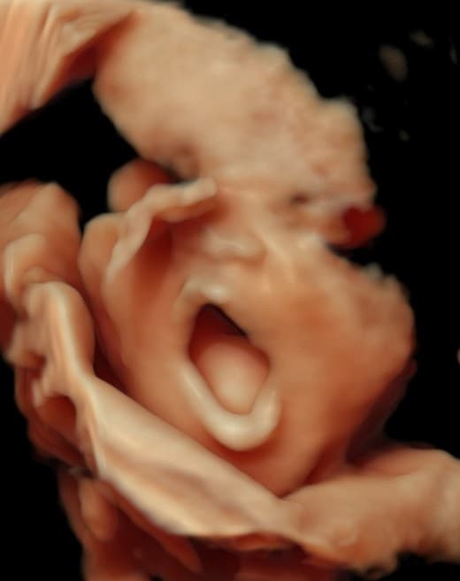 5D HD ultrasound of baby with a crying expression