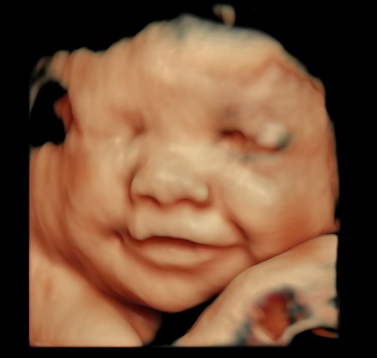 5D HD ultrasound of baby smiling while resting on hand