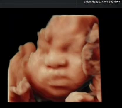 HDlive ultrasound image of a baby's face with both hands raised near the cheeks, shown with warm realistic light