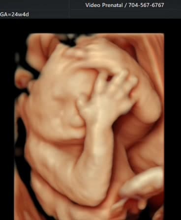 HDlive 3D ultrasound of a baby resting a tiny hand on the forehead, with soft light and detailed fingers