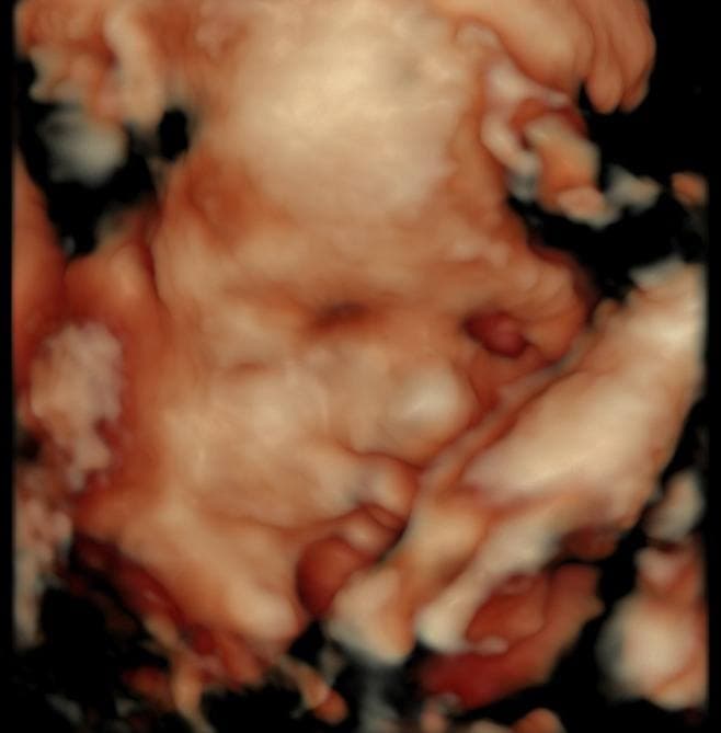 Low fluid intake baby ultrasound, blurry face