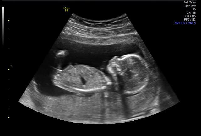 Video Prenatal Gender Reveal