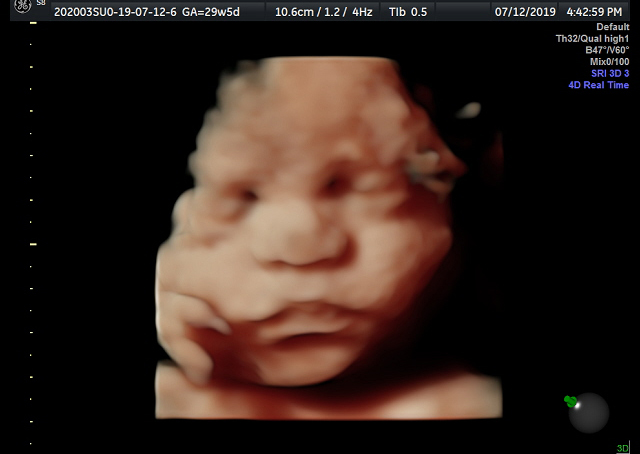 Galeria Charlotte3d4d And Hd Ultrasound