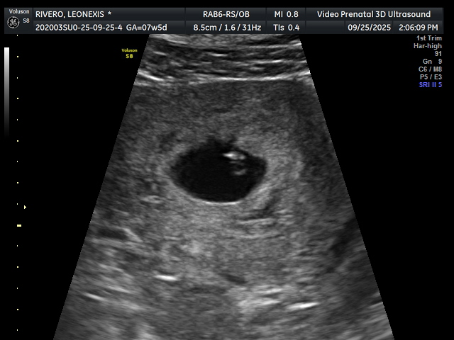 Video Prenatal - First Peek