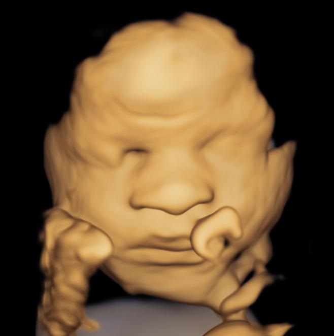 Good fluid Baby Ultrasound