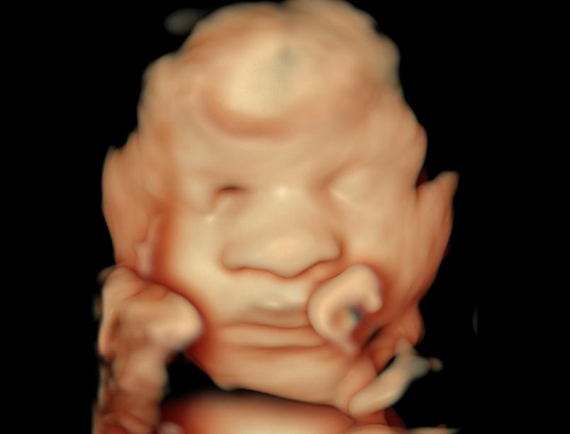Good fluid Baby Ultrasound